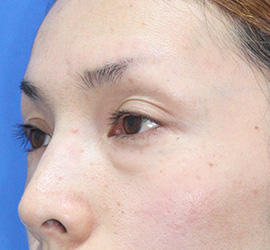 30代女性の目の下の脱脂  Before 症例写真