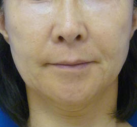 60代女性のリジュランHB After 症例写真