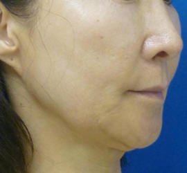 60代女性のリジュランHB After 症例写真