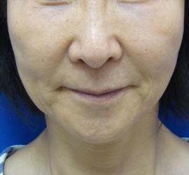 60代女性のリジュランHB Before 症例写真