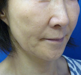 60代女性のリジュランHB Before 症例写真