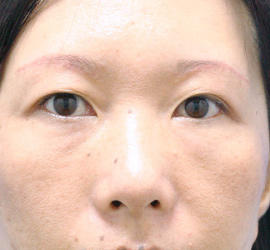40代女性の目の下の脱脂 After 症例写真