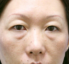 40代女性の目の下の脱脂 Before 症例写真