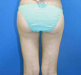 30代女性の脂肪吸引 After 症例写真