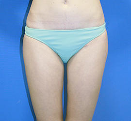 30代女性の脂肪吸引 After 症例写真