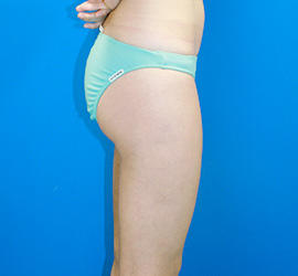 30代女性の脂肪吸引 After 症例写真