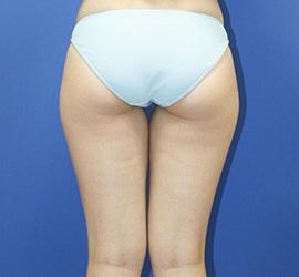 30代女性の脂肪吸引 Before 症例写真