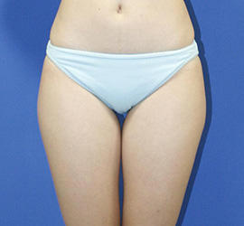 30代女性の脂肪吸引 Before 症例写真