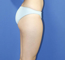 30代女性の脂肪吸引 Before 症例写真