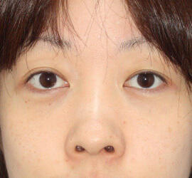 30代女性の目の下のクマ治療 After 症例写真