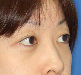 30代女性の目の下の脱脂  After 症例写真