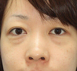 30代女性の目の下のクマ治療 Before 症例写真
