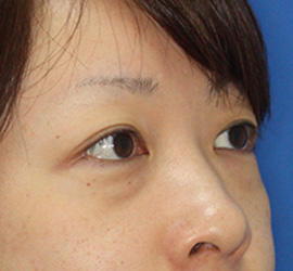 30代女性の目の下の脱脂  Before 症例写真