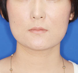 30代女性のシワ・たるみ After 症例写真