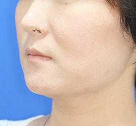 30代女性の顔の脂肪吸引  After 症例写真