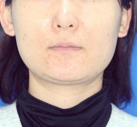 30代女性のシワ・たるみ Before 症例写真