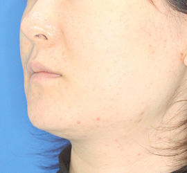 30代女性の顔の脂肪吸引  Before 症例写真