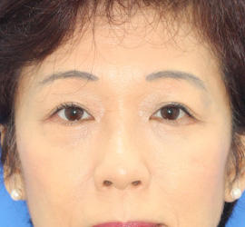 50代女性の下まぶたのたるみ取り After 症例写真