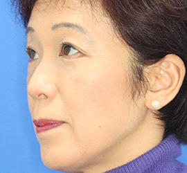 50代女性の下まぶたのたるみ取り After 症例写真