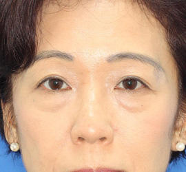50代女性の下まぶたのたるみ取り Before 症例写真