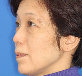 50代女性の下まぶたのたるみ取り Before 症例写真