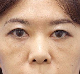 40代女性の目の下の脱脂 After 症例写真