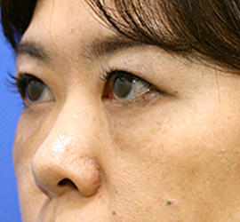 40代女性の目の下の脱脂  After 症例写真