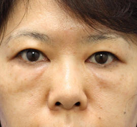 40代女性の目の下の脱脂 Before 症例写真
