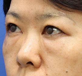 40代女性の目の下の脱脂  Before 症例写真