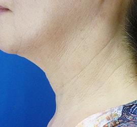 60代女性のリジュランHB After 症例写真