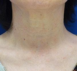 60代女性のリジュランHB Before 症例写真