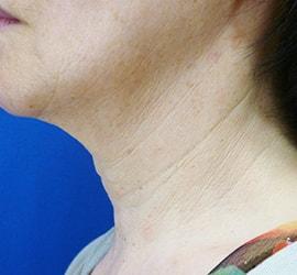 60代女性のリジュランHB Before 症例写真