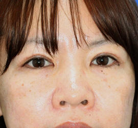 40代女性の上まぶたのたるみ取り After 症例写真
