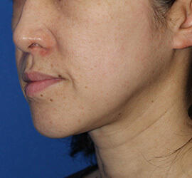 40代女性のメディカル美肌セレクト After 症例写真