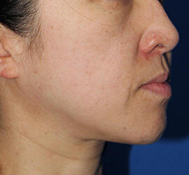 40代女性のメディカル美肌セレクト After 症例写真