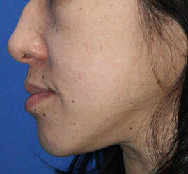 40代女性のメディカル美肌セレクト Before 症例写真