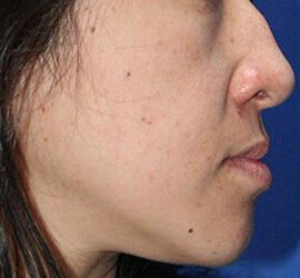 40代女性のメディカル美肌セレクト Before 症例写真