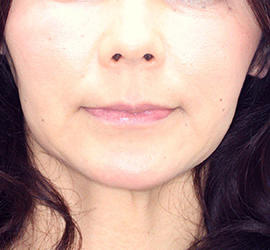 40代女性のサーマクール Before 症例写真