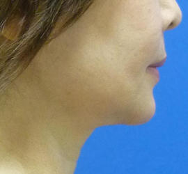 50代女性のボトックス（輪郭＆広頚筋ボトックス） After 症例写真