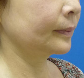 50代女性のボトックス（輪郭＆広頚筋ボトックス） After 症例写真