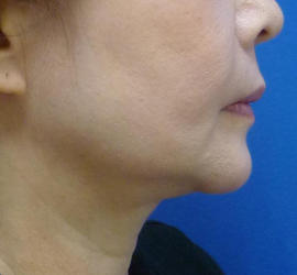 50代女性のボトックス（輪郭＆広頚筋ボトックス） Before 症例写真