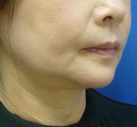 50代女性のボトックス（輪郭＆広頚筋ボトックス） Before 症例写真