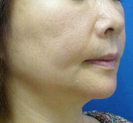 50代女性のシワ・たるみ After 症例写真