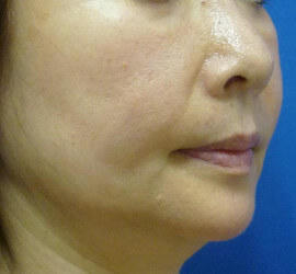 50代女性のシワ・たるみ Before 症例写真