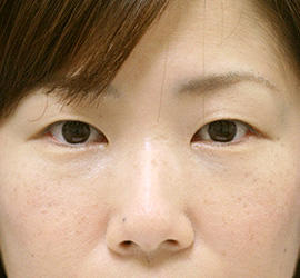 40代女性のサーマクール After 症例写真