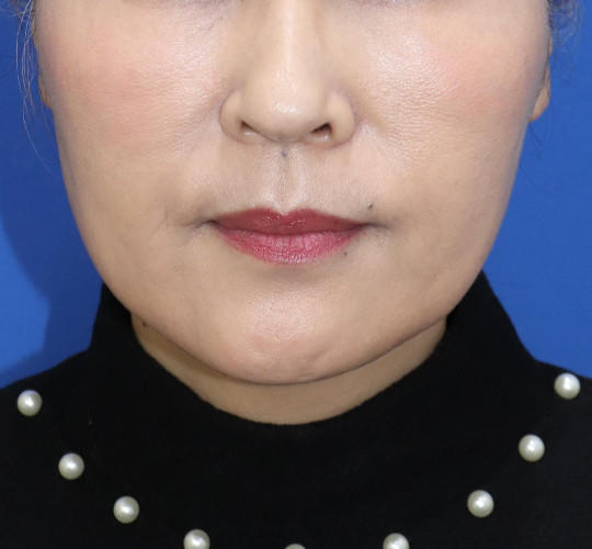50代女性の顔の脂肪吸引  After 症例写真
