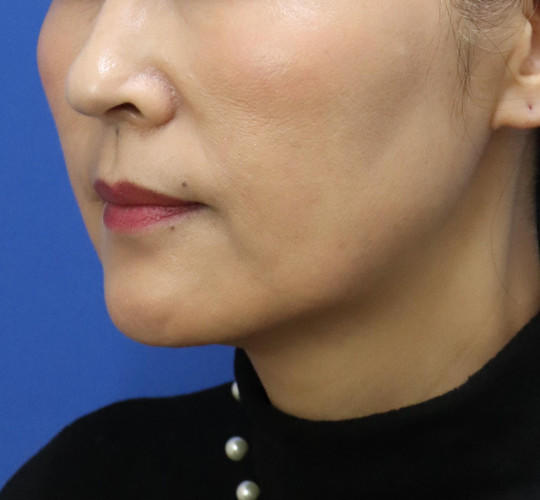 50代女性の顔の脂肪吸引 After 症例写真