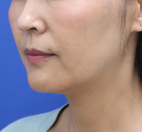 50代女性の顔の脂肪吸引 Before 症例写真