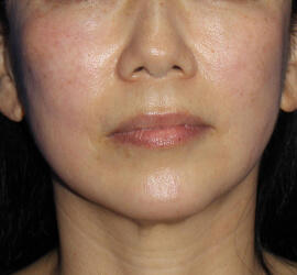 50代女性の After 症例写真