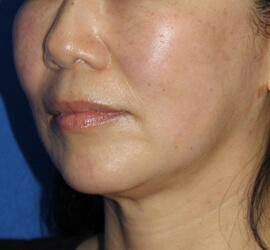 50代女性のシワ・たるみ After 症例写真